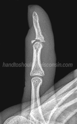 Mallet fracture with bone fragment