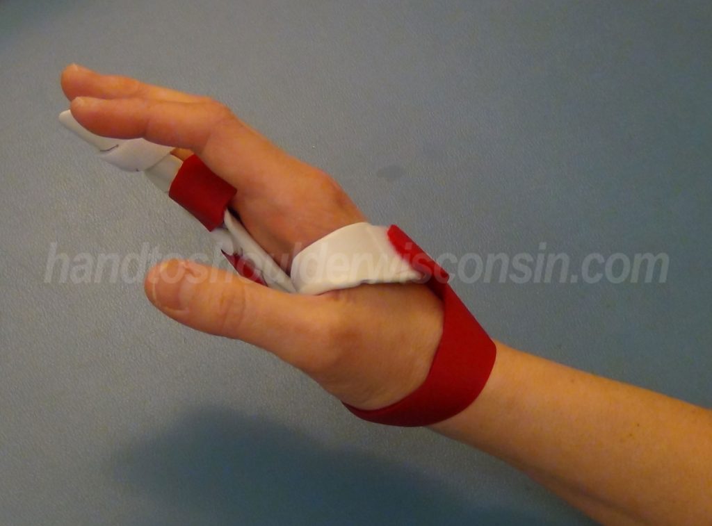 Hand to Shoulder Center of Wisconsin Dupuytren's contracture