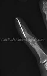 Mallet finger pin – side view
