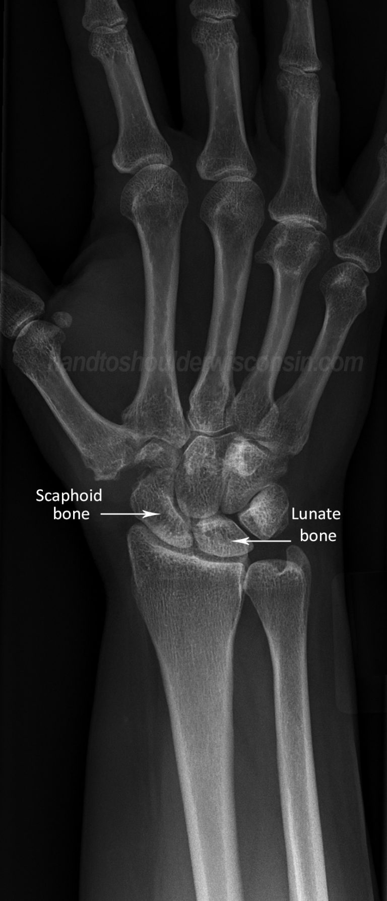 Hand to Shoulder Center of Wisconsin | Ligament Injury