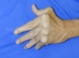 Rheuma arthritis finger