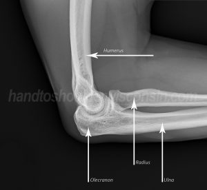 The three bones of the elbow