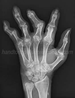 Hand to Shoulder Center of Wisconsin | Finger Fracture