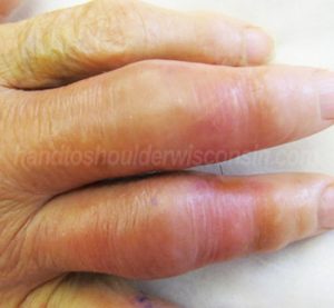 Inflamed arthritic finger joints
