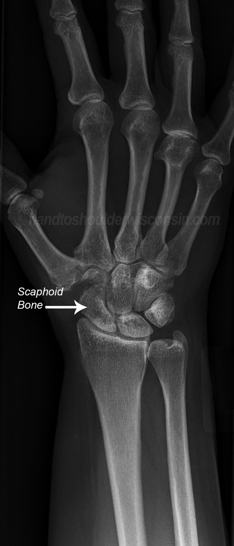 Hand to Shoulder Center of Wisconsin | Scaphoid Fracture