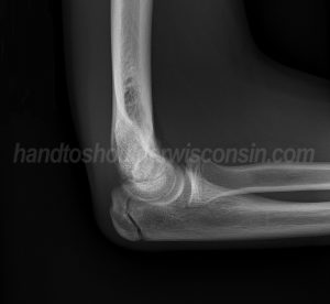 X-ray view of a child’s olecranon stress fracture