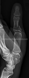 Thumb fracture