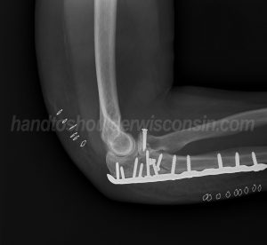 Severe fractures often require hardware to stabilize the bone and bone fragments
