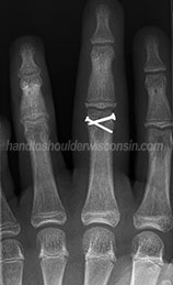 Finger fracture screws