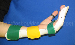Extensor and flexor tendon fabricated splints